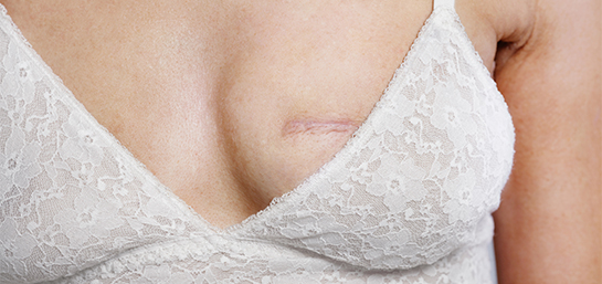 ¿Un seguro privado puede cubrir una mastectomía?