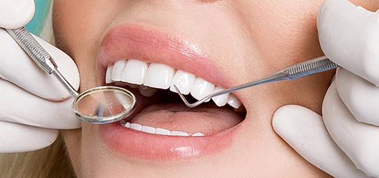 Carillas en el Seguro Dental de MAPFRE: ¿Están cubiertas?